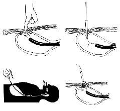 gastrostomia-endoscopica-percutanea-20110314141920